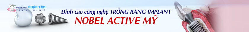 Cấy ghép răng implant toàn hàm