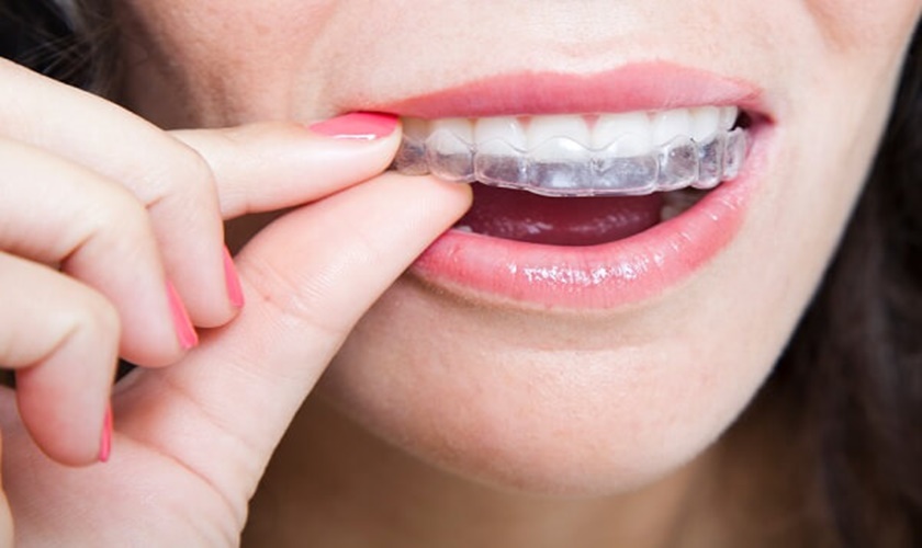 Niềng răng máng trong suốt đảm bảo tính thẩm mỹ hiệu quả